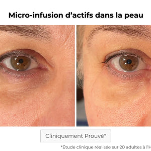 Patch contour des yeux micro-aiguilles avant-après — effet tenseur immédiat et anti-fatigue
