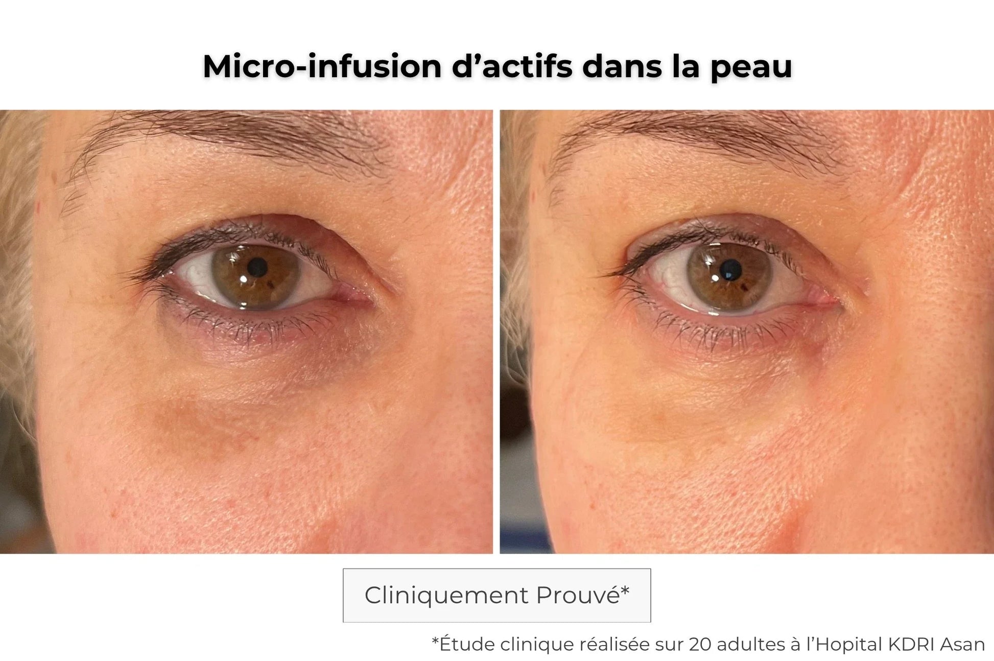 Patch contour des yeux micro-aiguilles avant-après — effet tenseur immédiat et anti-fatigue