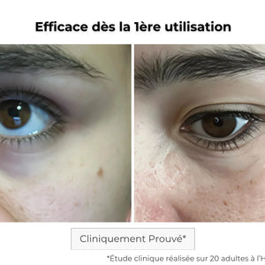 Résultats patch contour des yeux microneedling : peau lissée, cernes atténués
