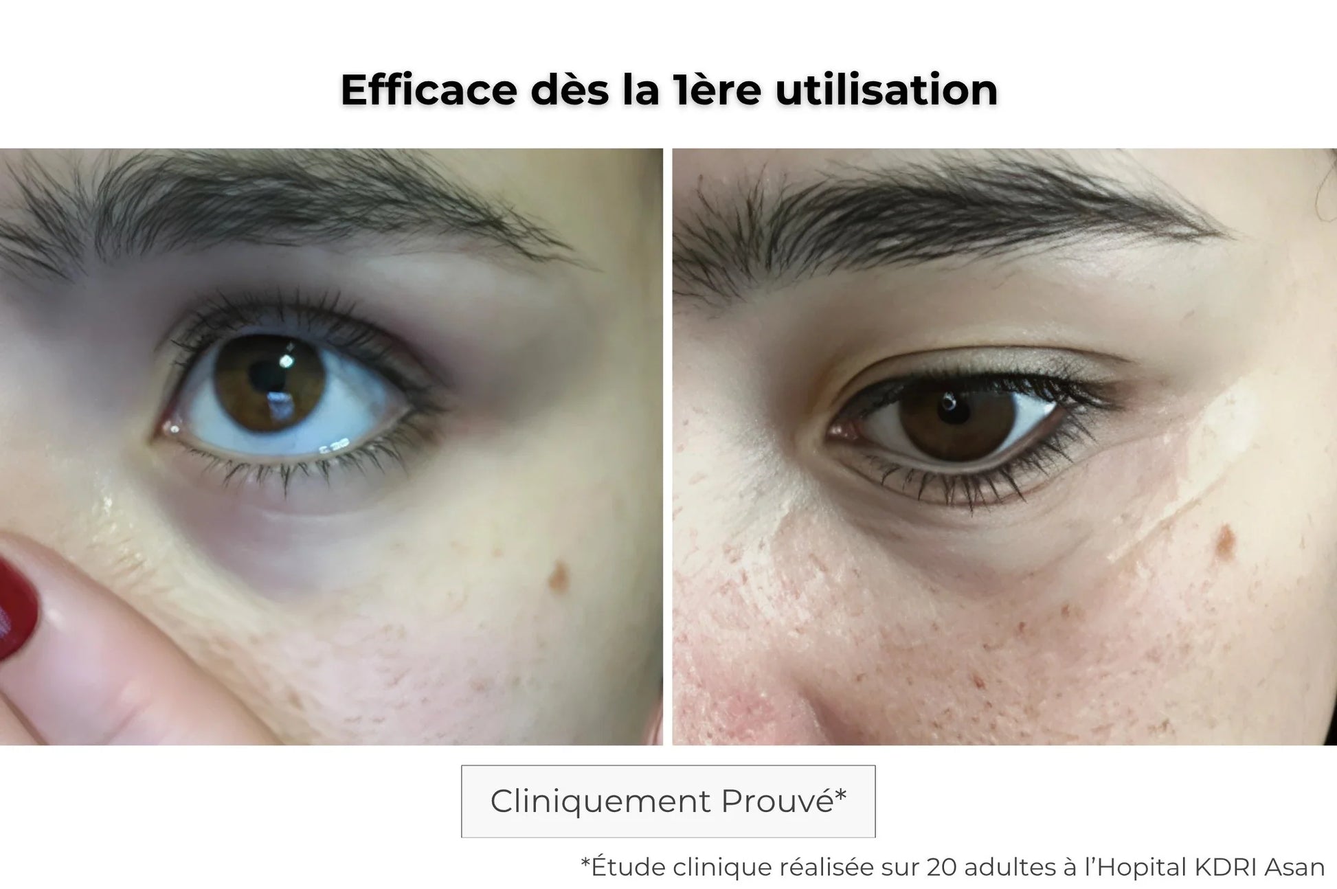 Résultats patch contour des yeux microneedling : peau lissée, cernes atténués