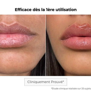 Avant / après patch lèvres à micro-aiguilles — effet repulpant visible dès la première application