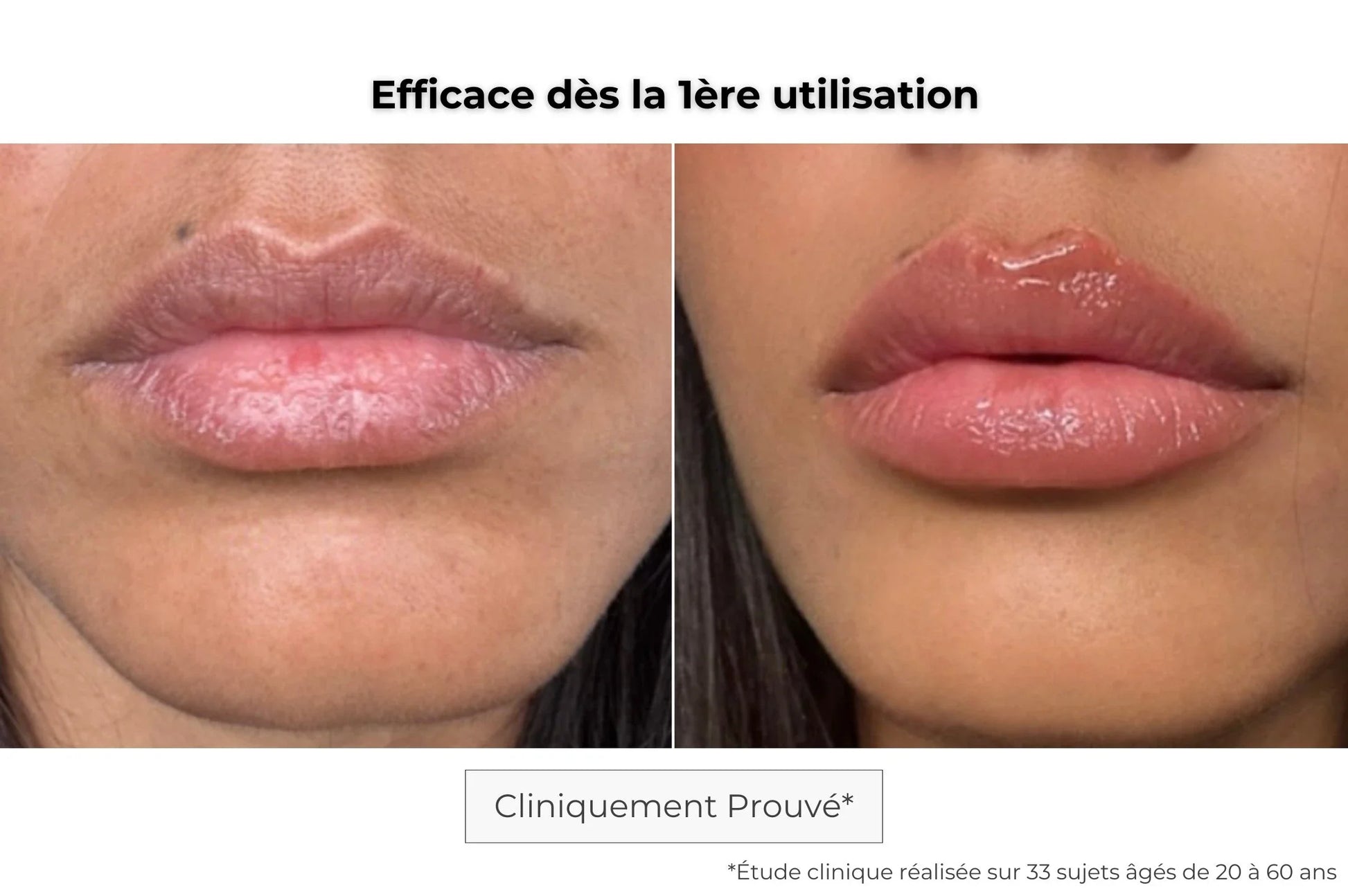 Avant / après patch lèvres à micro-aiguilles — effet repulpant visible dès la première application