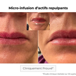 Patch lèvres avant-après — repulpant naturel et hydratation durable grâce à la technologie micro-aiguilles