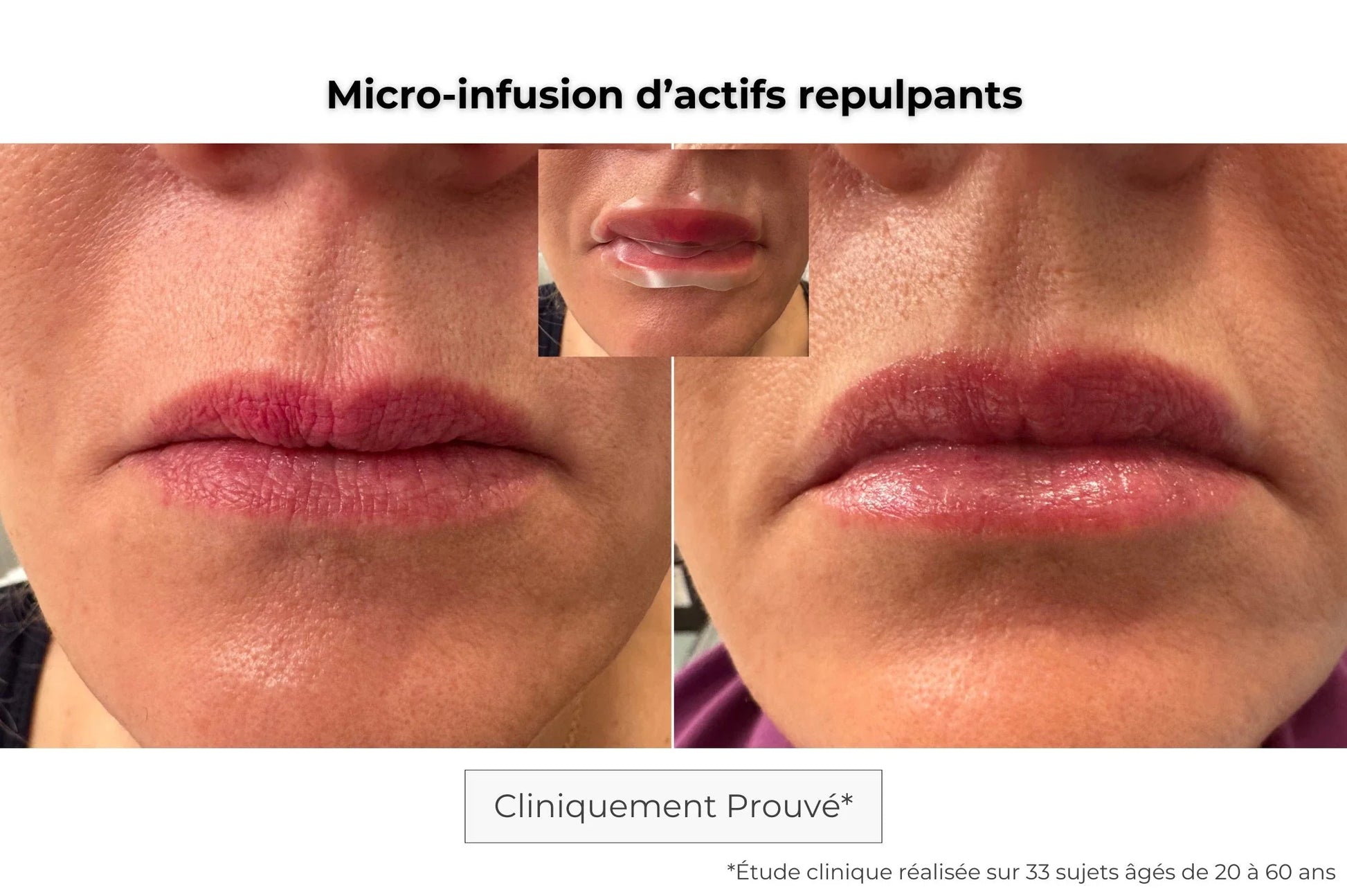 Patch lèvres avant-après — repulpant naturel et hydratation durable grâce à la technologie micro-aiguilles