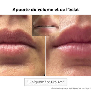 Résultats patch lèvres microneedling : lèvres repulpées, douces et hydratées en profondeur
