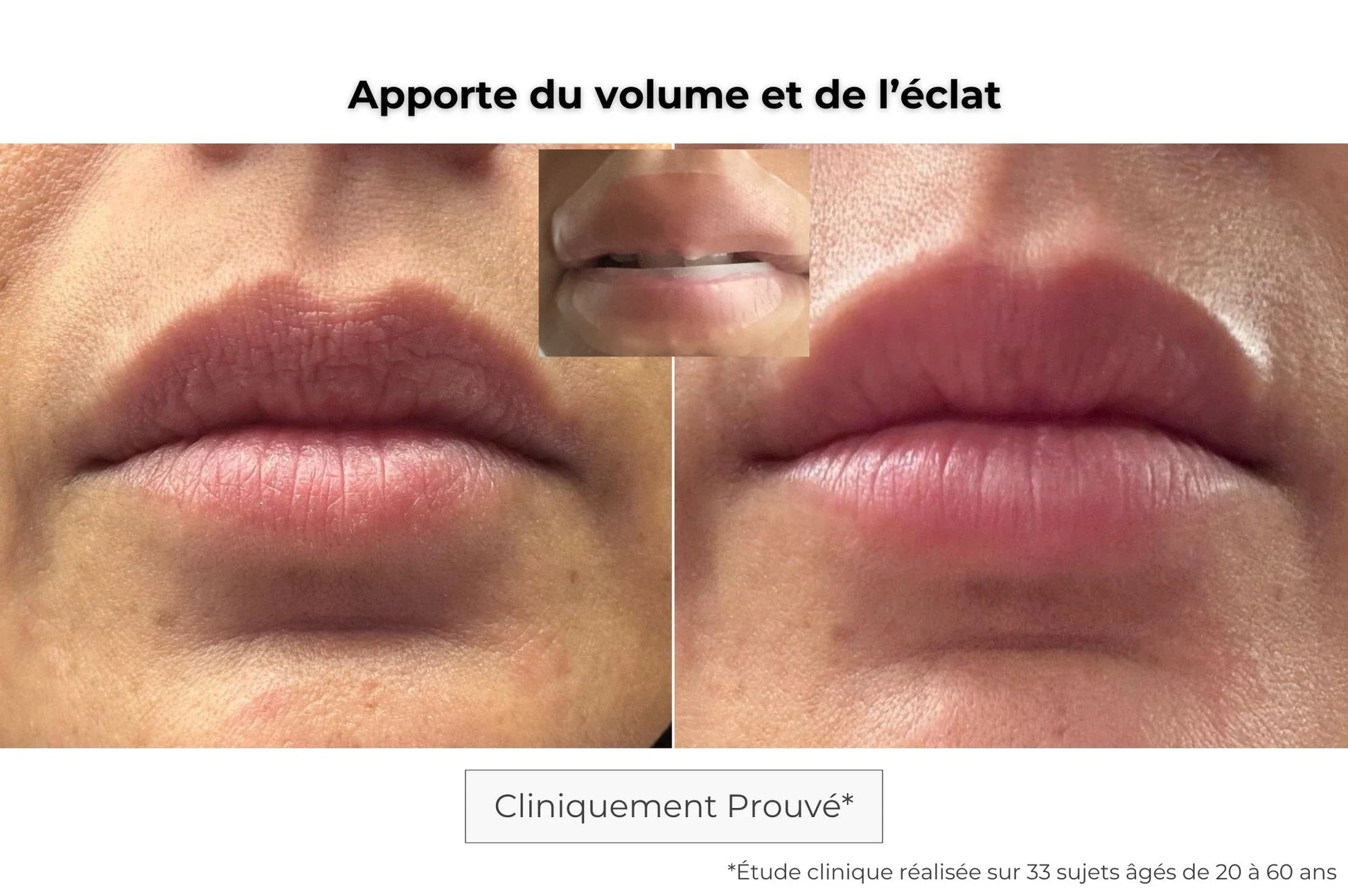 Résultats patch lèvres microneedling : lèvres repulpées, douces et hydratées en profondeur