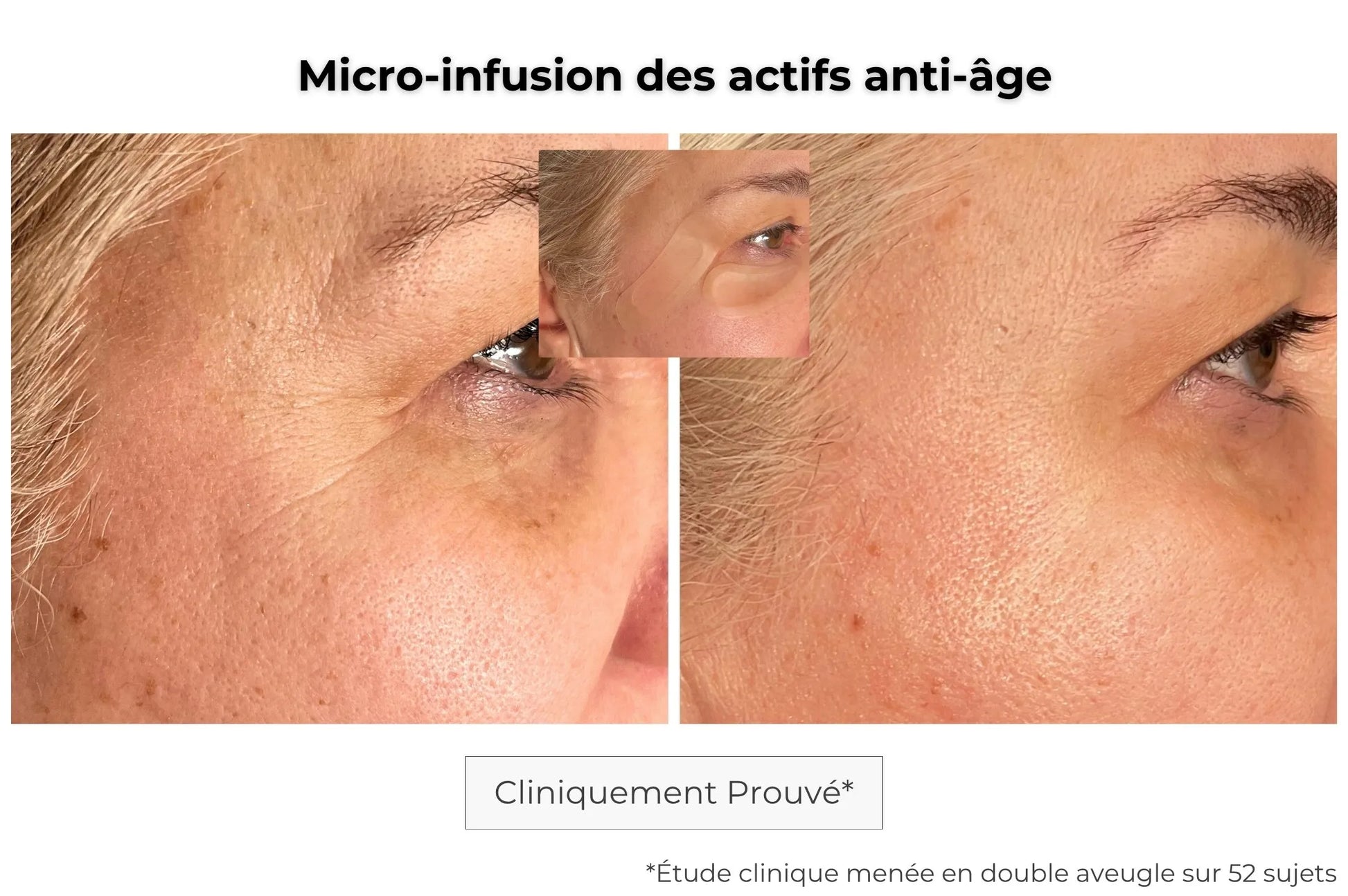 Patch anti-âge microstructure avant-après — effet liftant immédiat et durable