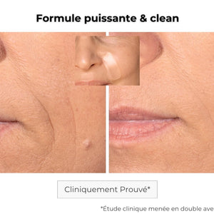 Résultats patch anti-âge microneedling : réduction visible des rides d’expression