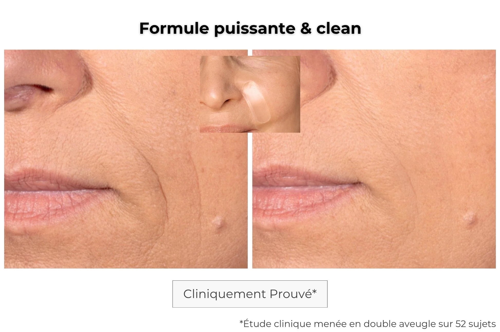 Résultats patch anti-âge microneedling : réduction visible des rides d’expression